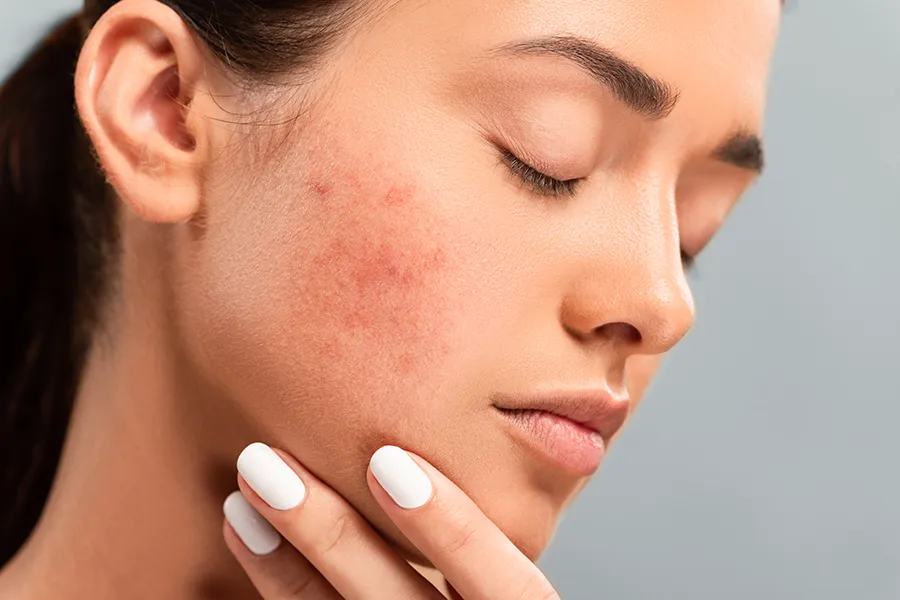 Acne-Clinic Side profile of a woman touching her irritated cheek with visible acne, representing the personalized acne solutions available by Vitality Medical in Seattle.