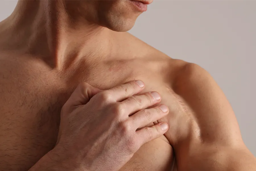 Scars-and-Stretch-Marks-Clinic A man with a scar on his shoulder. Get treatment for scars and stretch marks from Vitality Medical in Seattle.