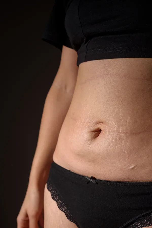 Scars-and-Stretch-Marks-Treatment A woman with stretch marks on her abdomen. Get treatment for scars and stretch marks from Vitality Medical in Seattle.